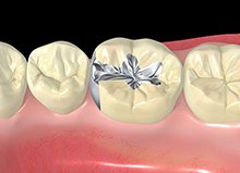 補綴物の種類のイメージ