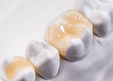 補綴物の種類のイメージ