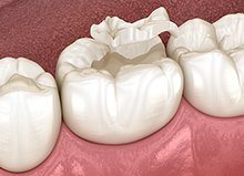 補綴物の種類のイメージ