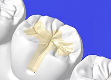 補綴物の種類のイメージ