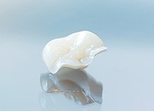 補綴物の種類のイメージ