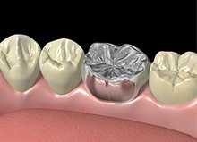 補綴物の種類のイメージ