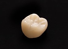 補綴物の種類のイメージ