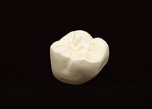 補綴物の種類のイメージ