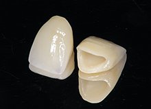 補綴物の種類のイメージ