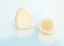 補綴物の種類のイメージ