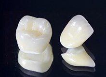 補綴物の種類のイメージ