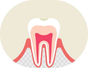 脱灰 イメージ1