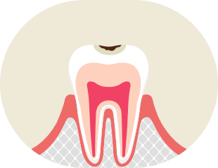 エナメル質う蝕 イメージ1