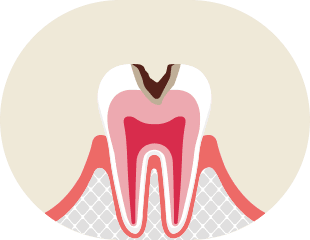 象牙質う蝕 イメージ1