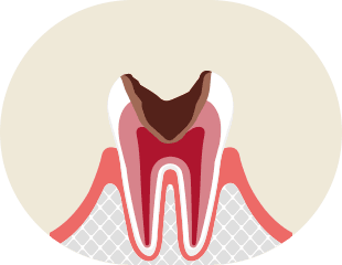歯髄炎・根尖性歯周炎 イメージ1