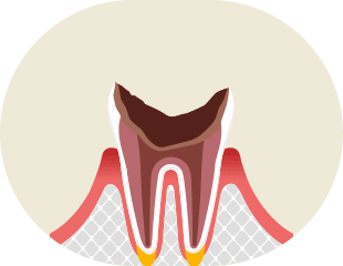 残根 イメージ1