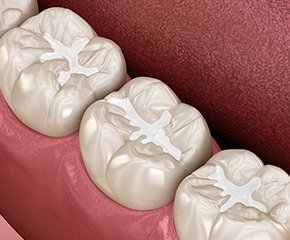 CR充填（コンポジットレジン充填） イメージ