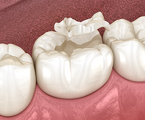 インレー イメージ