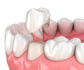 クラウン（被せ物） イメージ