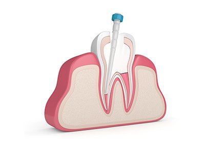 神経まで進行している場合の治療 イメージ