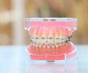 ワイヤー矯正の活用