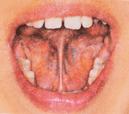 舌全体が上あごについている