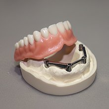 アタッチメント義歯 イメージ