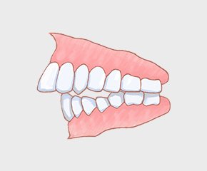 上顎前突（じょうがくぜんとつ）