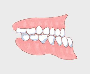 下顎前突（かがくぜんとつ）