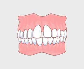 空隙歯列（くうげきしれつ）