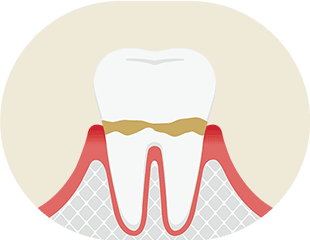 歯肉炎 イメージ