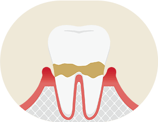 軽度歯周炎 イメージ