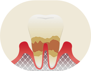 中等度歯周炎 イメージ