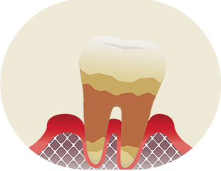 重度歯周炎 イメージ