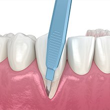 フラップ手術 イメージ